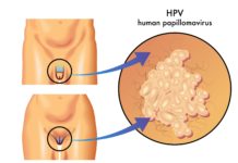 Vacuna para el VPH