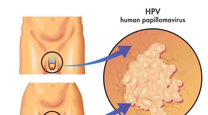 Vacuna para el VPH